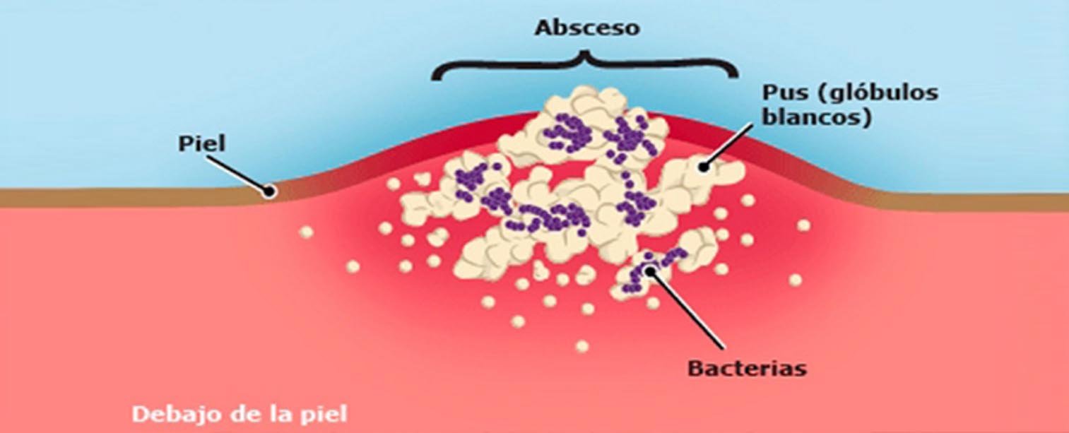 Absceso
