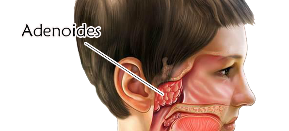 Adenoides