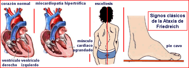 Ataxia de Friedreich