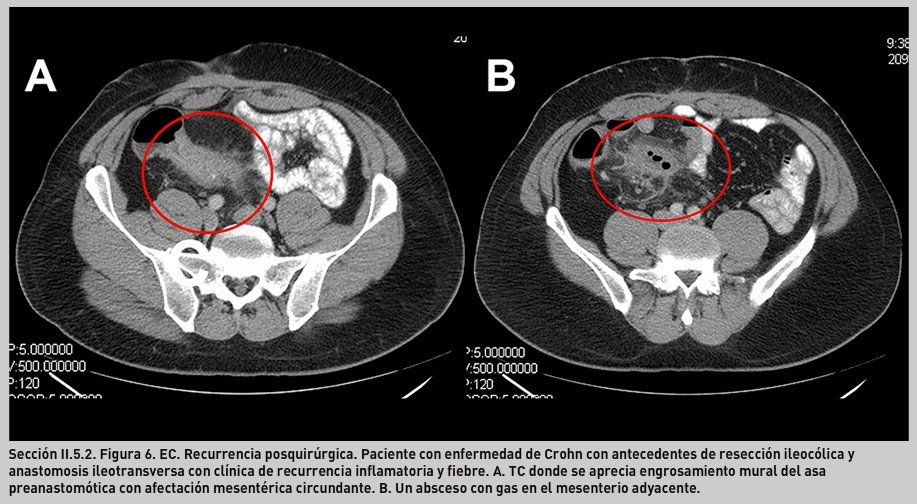 Ileitis, enfermedad de Crohn