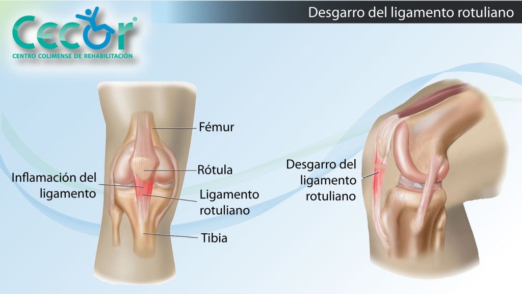 Desgarro de Ligamentos