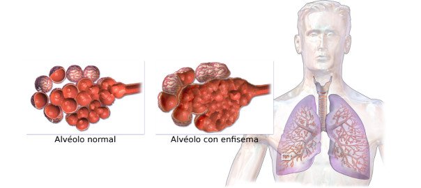 Enfisema Pulmonar