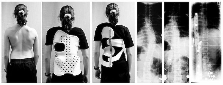 Escoliosis: Problemas en la Espalda