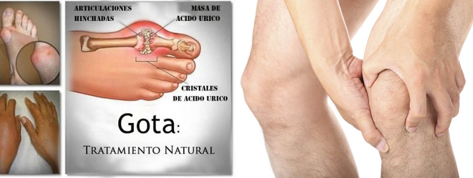 Gota – Acido Úrico