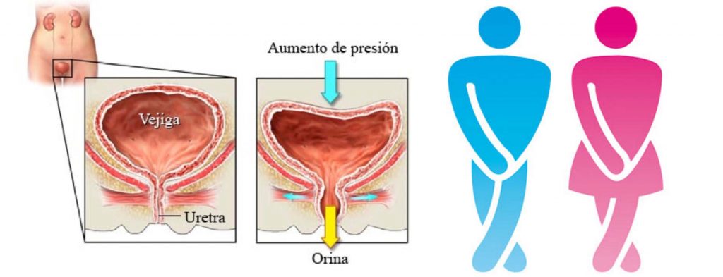 Incontinencia Fundación Sonría