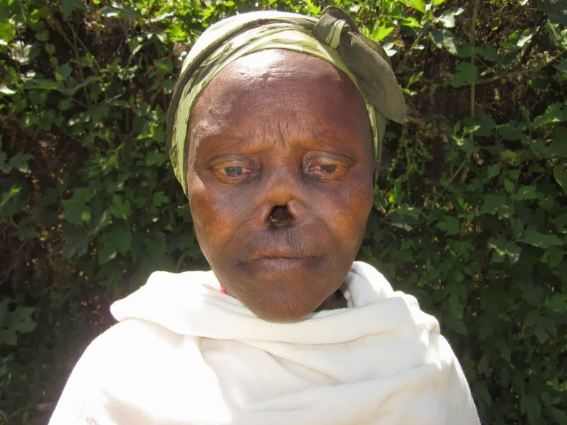 Lepra, Enfermedad de Hansen