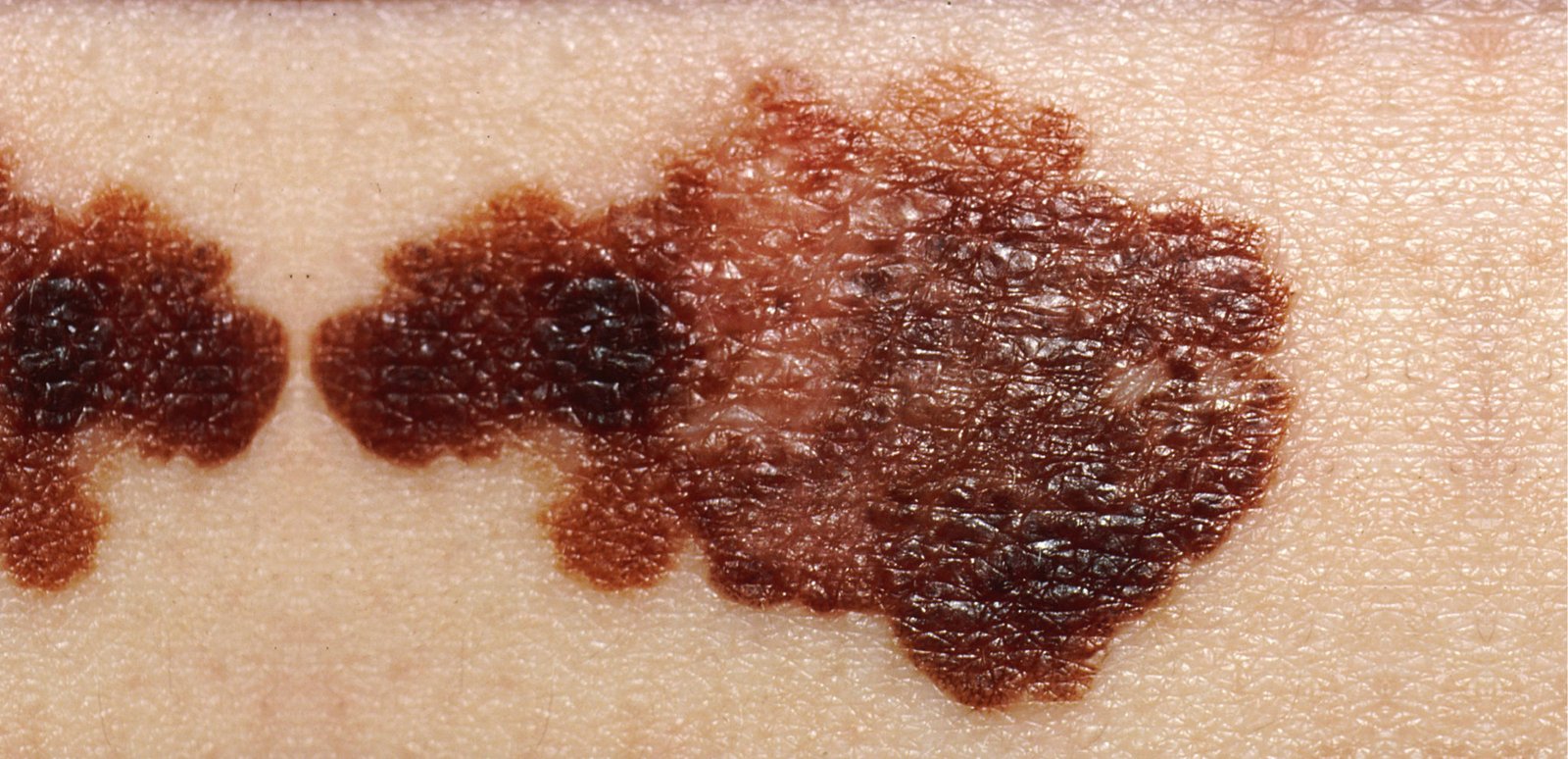 Melanoma Maligno