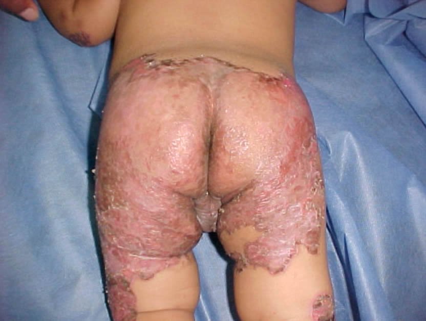 Acrodermatitis y Acroqueratosis