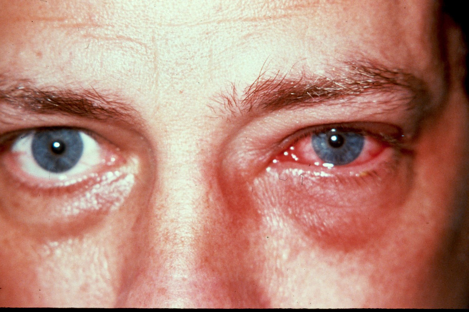 Conjuntivitis