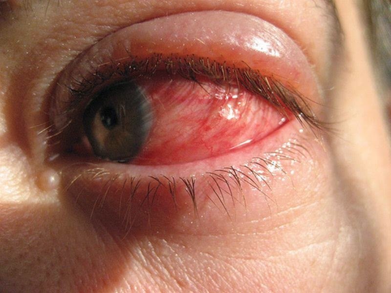 Conmoción y Desprendimiento de la Retina