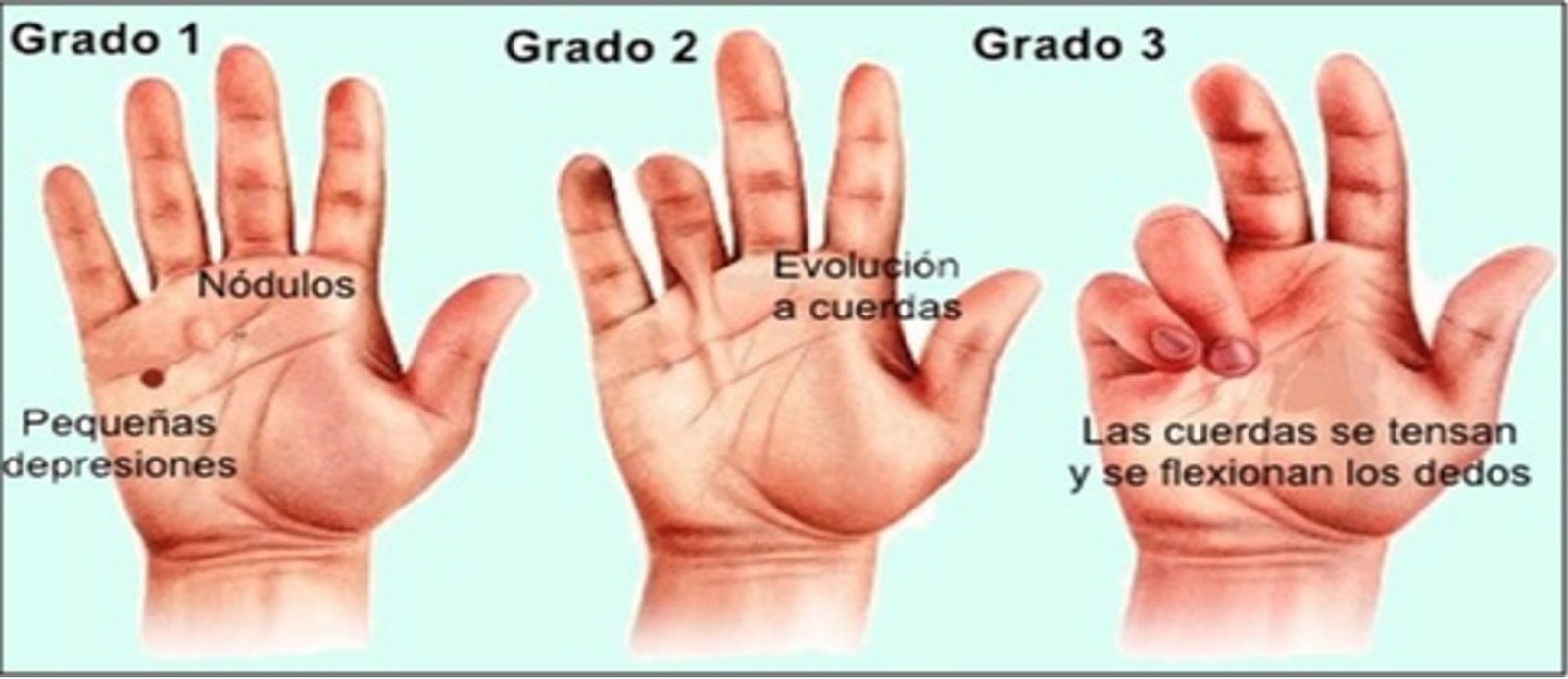 Desviación de Dupuytren