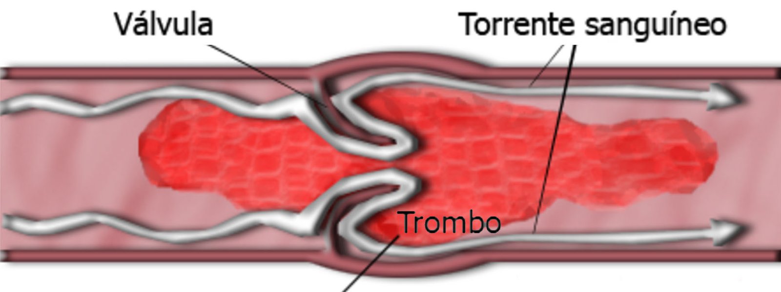 Trombosis
