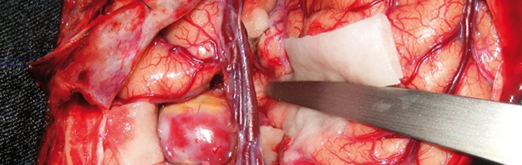 Hemorragia Sanguínea