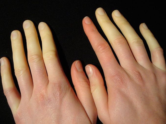 Enfermedad de Raynaud