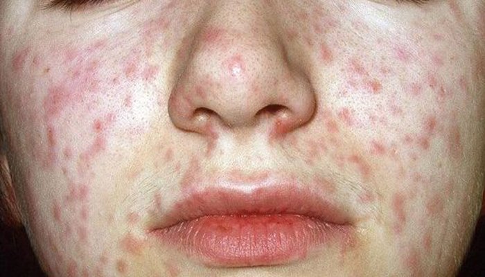 Enfermedades hasta los 10 Años