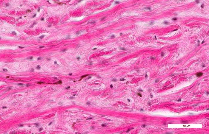 Debilidad de los Tejidos Conjuntivos
