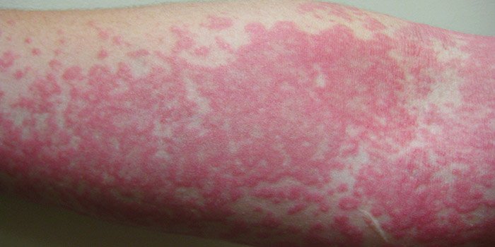 Urticaria, Ezema