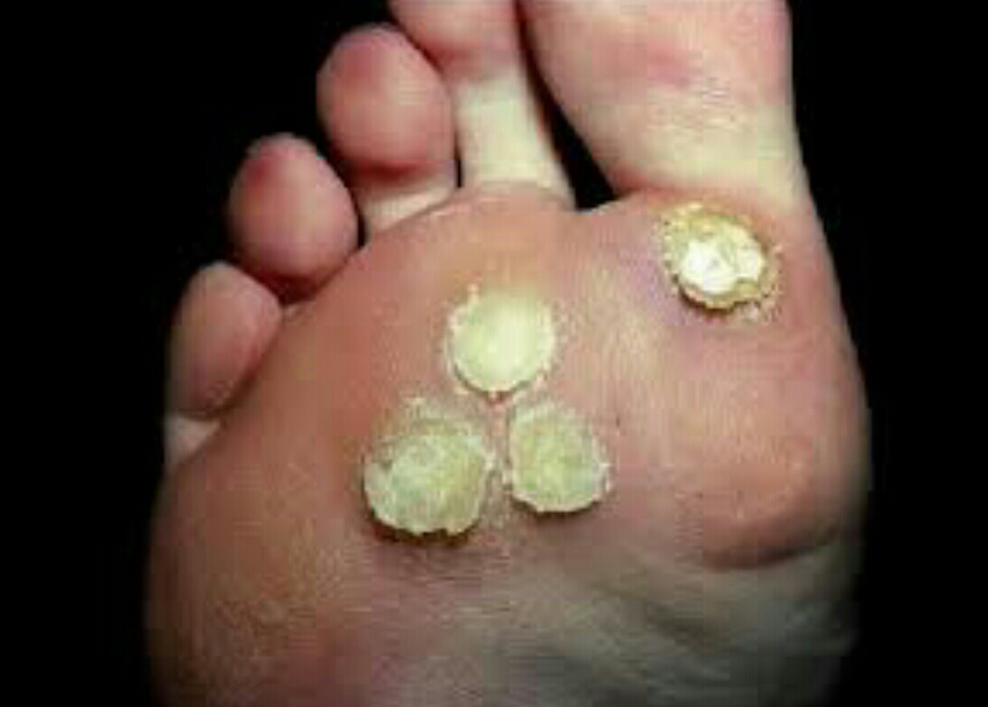 Verrugas en los Piés