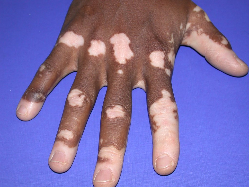 Vitíligo, Leucoderma