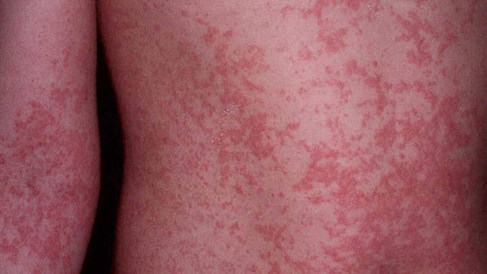 Brotes, Erupción, Sarpullido