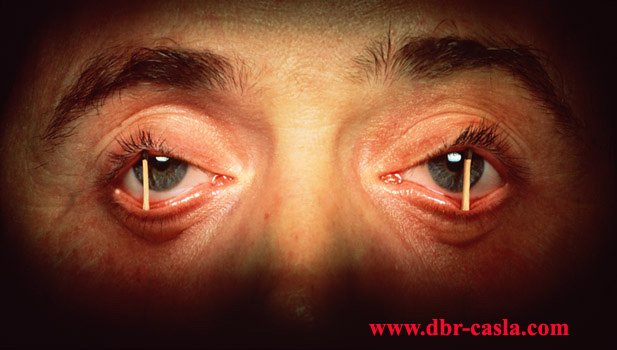 Somnolencia o Insomnio