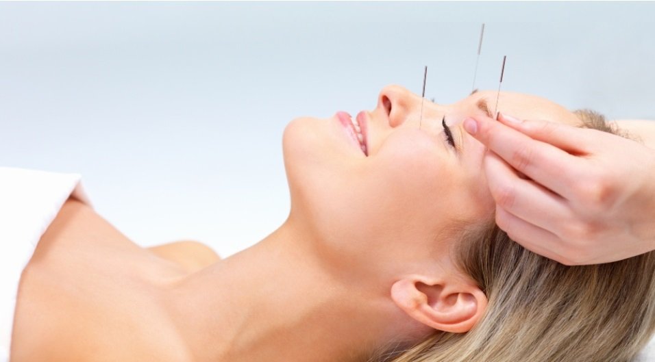 Acupuntura
